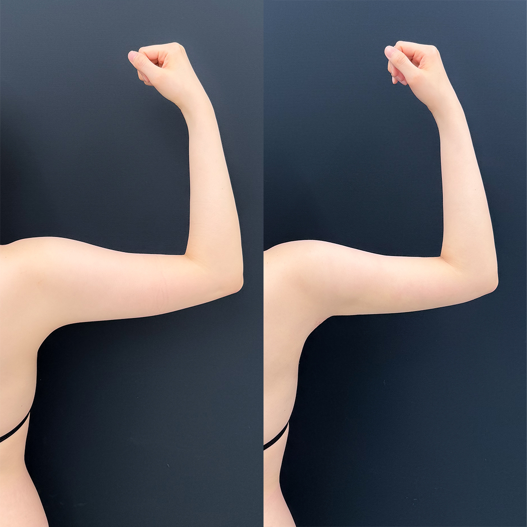 https://purelys-tokyo-clinic.com/wp/wp-content/uploads/2025/11/arm-Liposuction_Case-No.27.jpg
