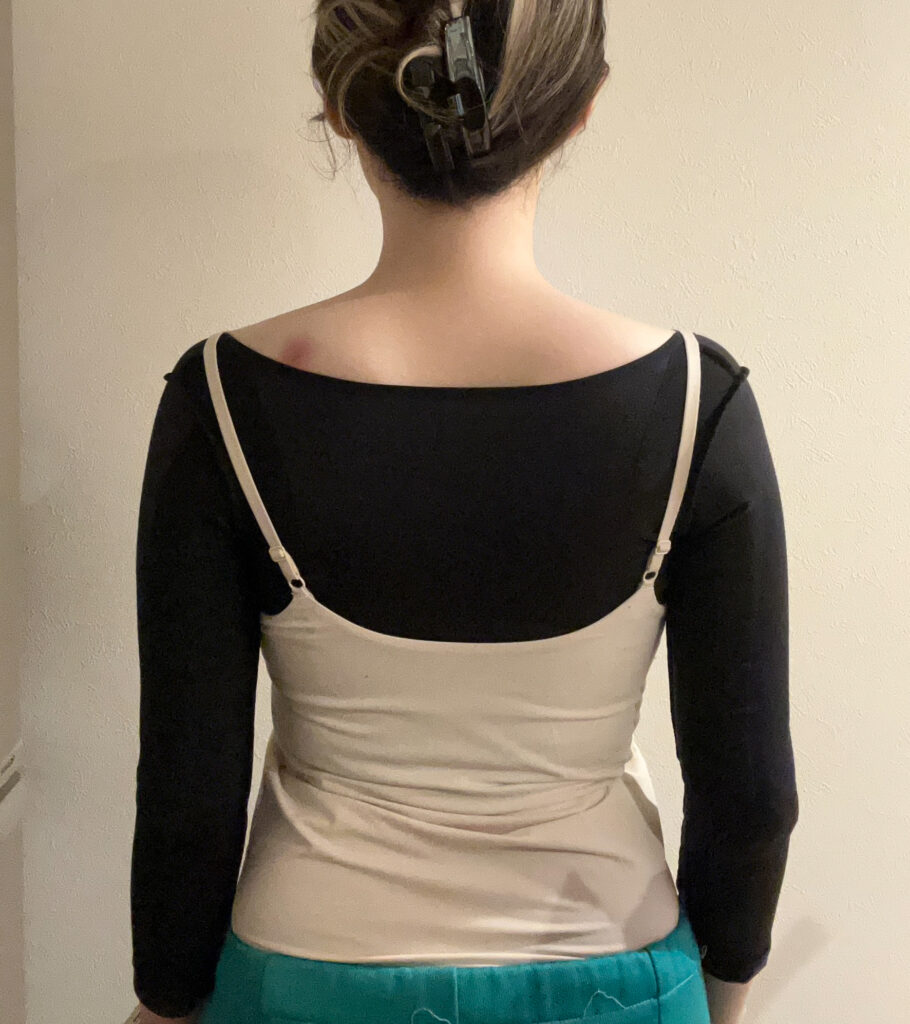 二の腕の脂肪吸引