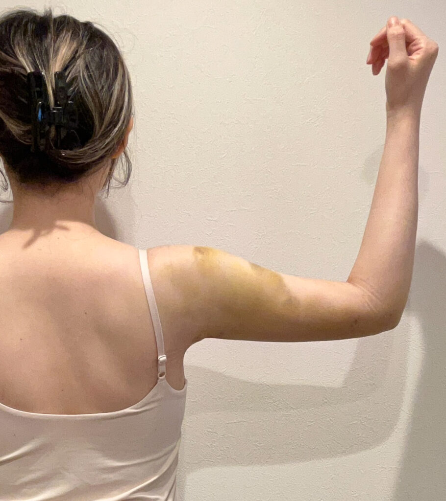 二の腕の脂肪吸引