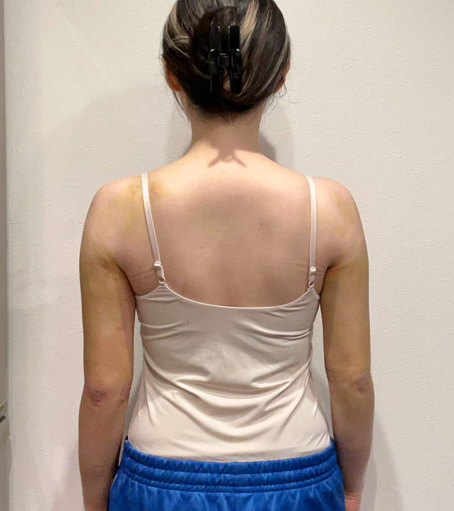 二の腕の脂肪吸引