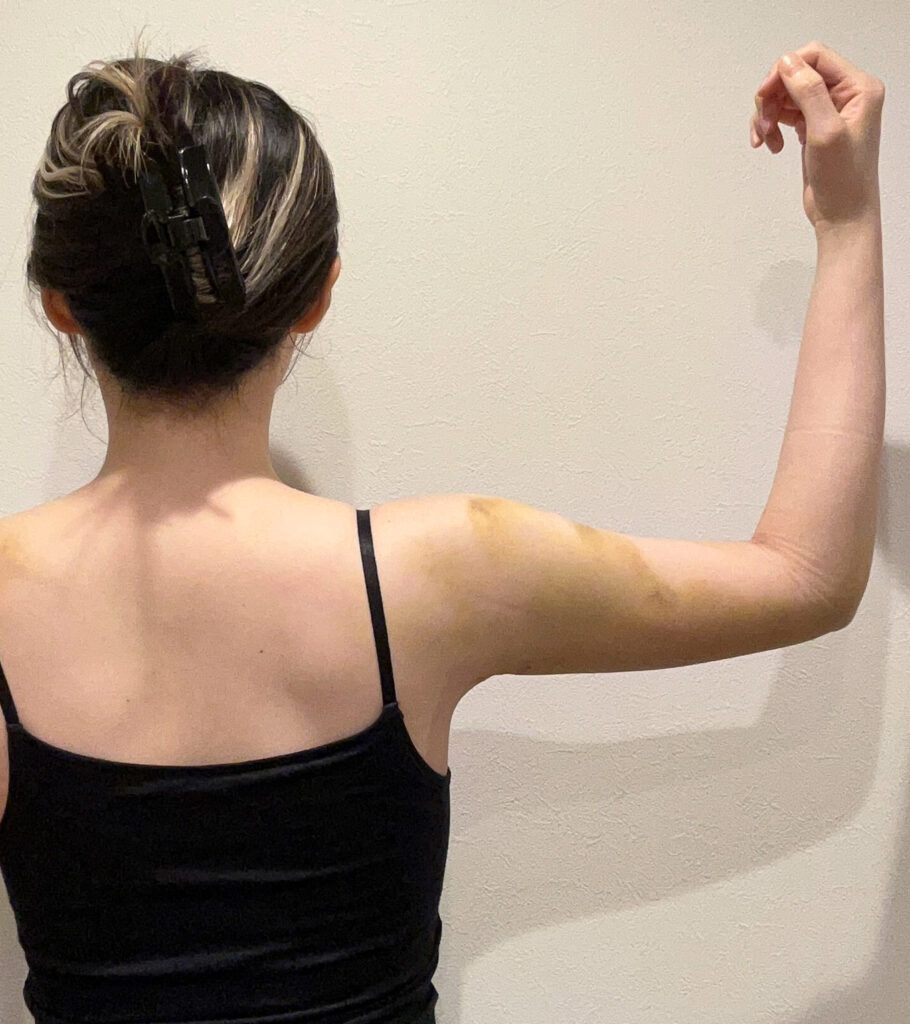 二の腕の脂肪吸引