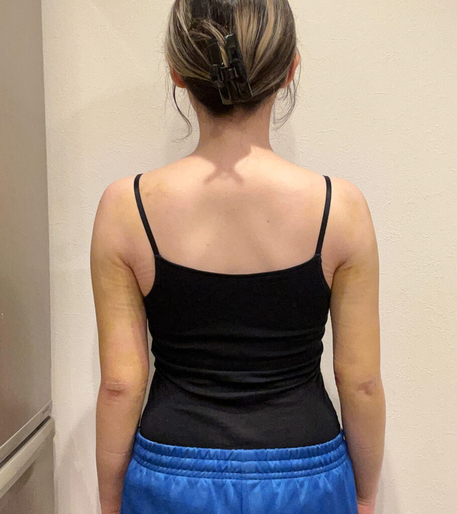 二の腕の脂肪吸引