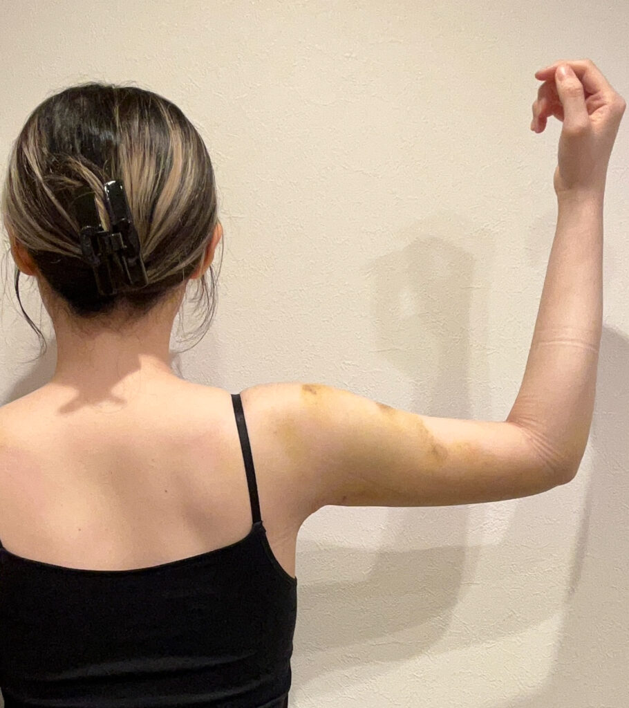 二の腕の脂肪吸引