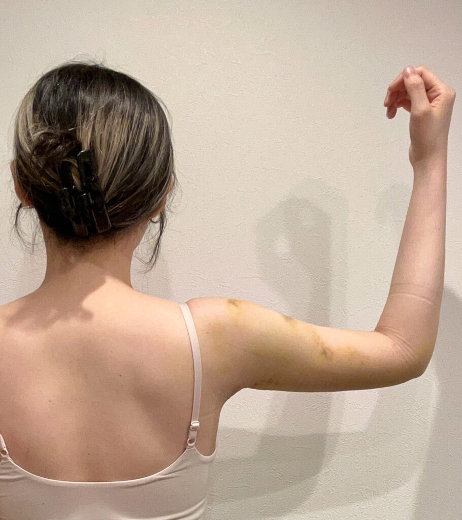 二の腕の脂肪吸引