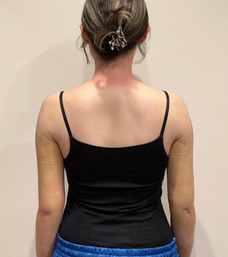 二の腕脂肪吸引