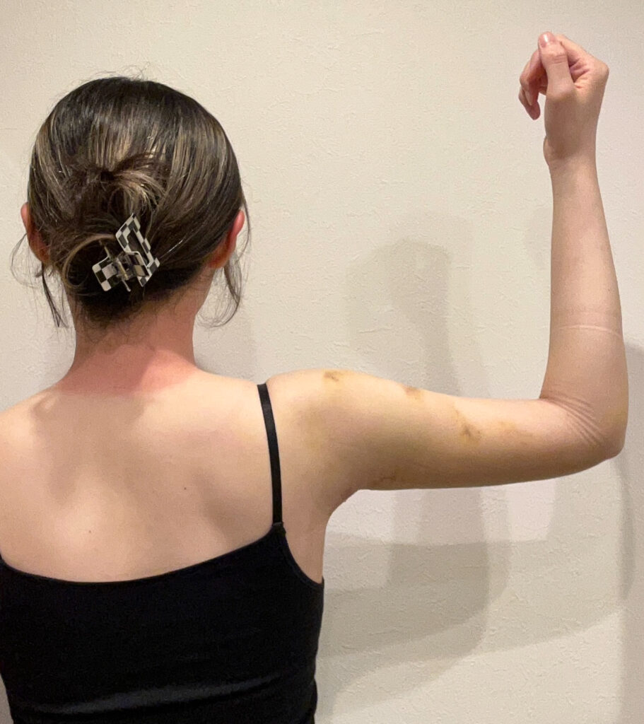 二の腕脂肪吸引