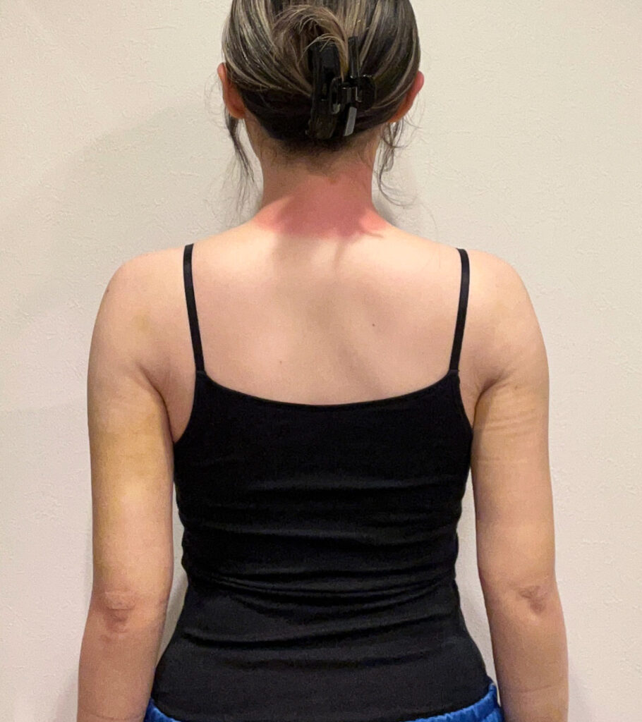 二の腕の脂肪吸引