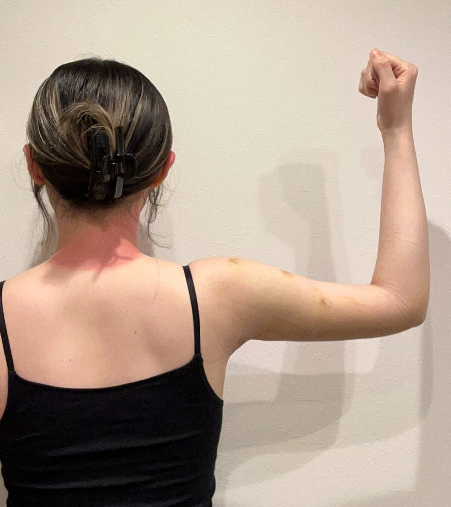 二の腕の脂肪吸引