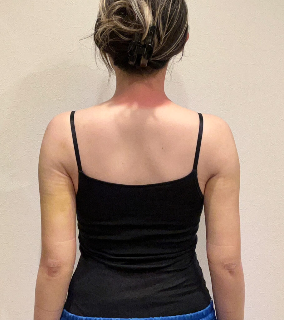 二の腕の脂肪吸引