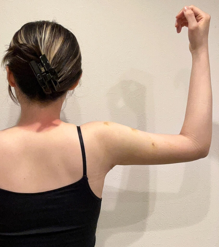 二の腕の脂肪吸引