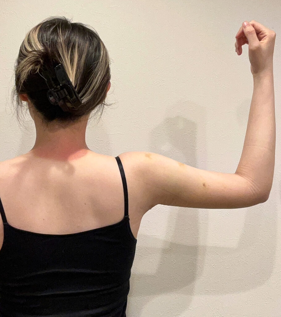 二の腕の脂肪吸引