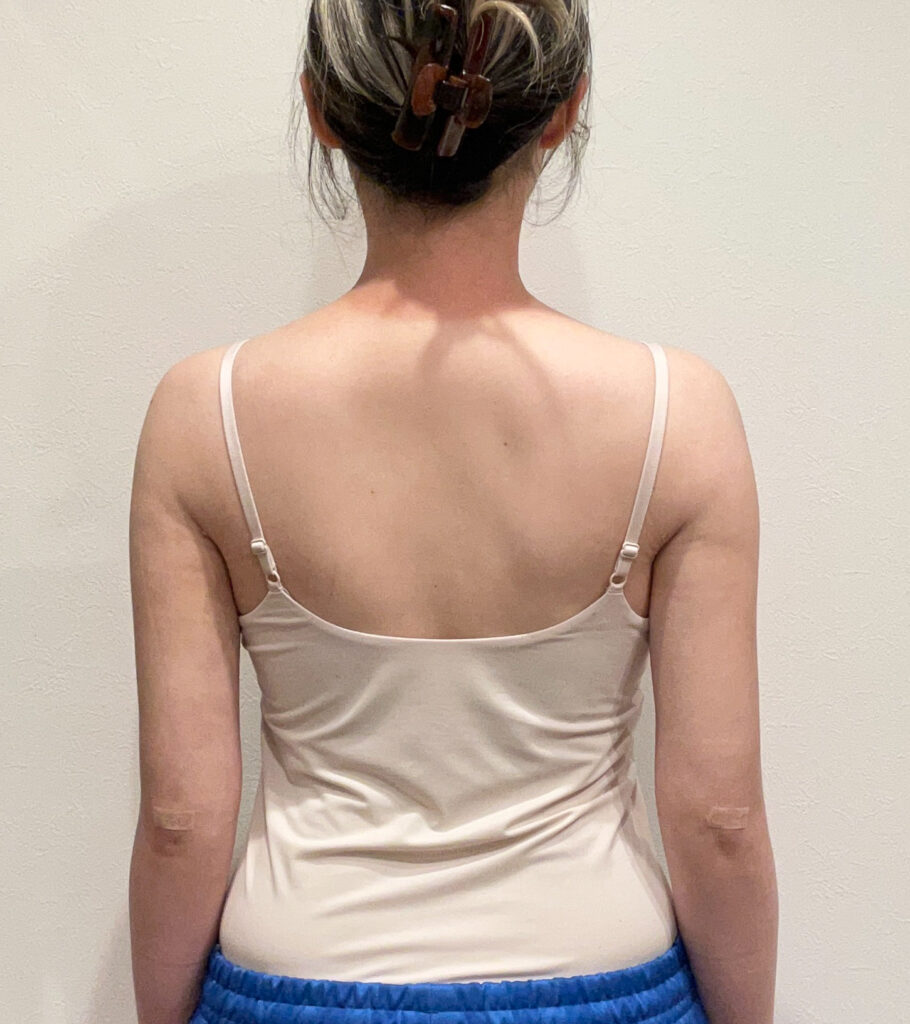 二の腕の脂肪吸引