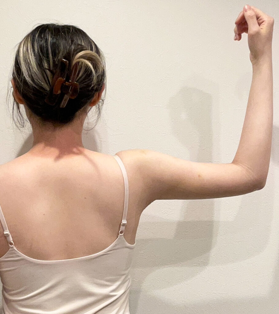 二の腕の脂肪吸引