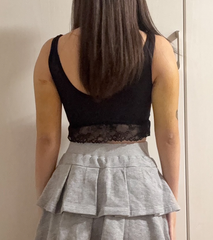 二の腕の脂肪吸引