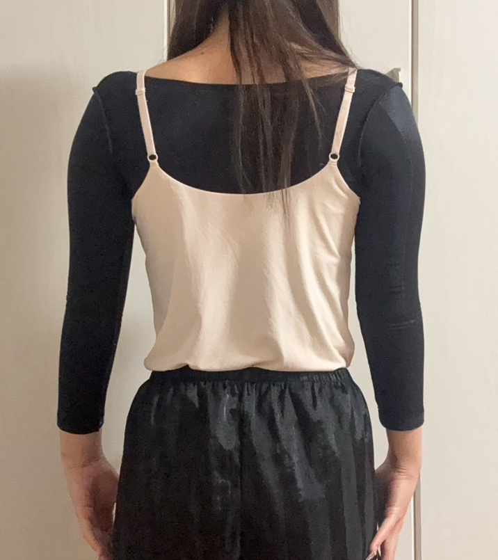 二の腕の脂肪吸引