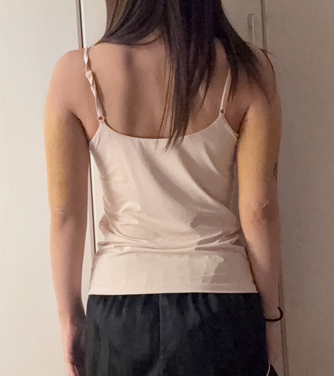 二の腕の脂肪吸引