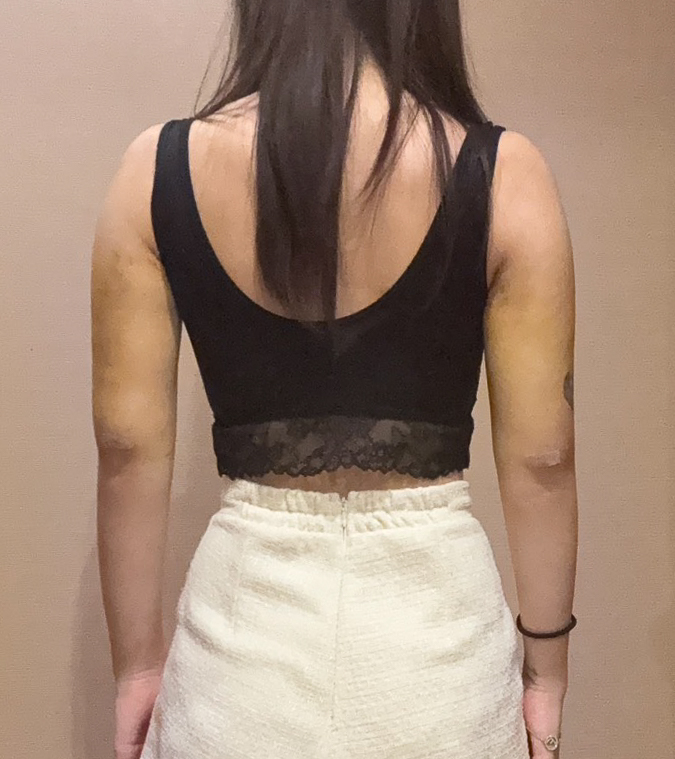 二の腕の脂肪吸引