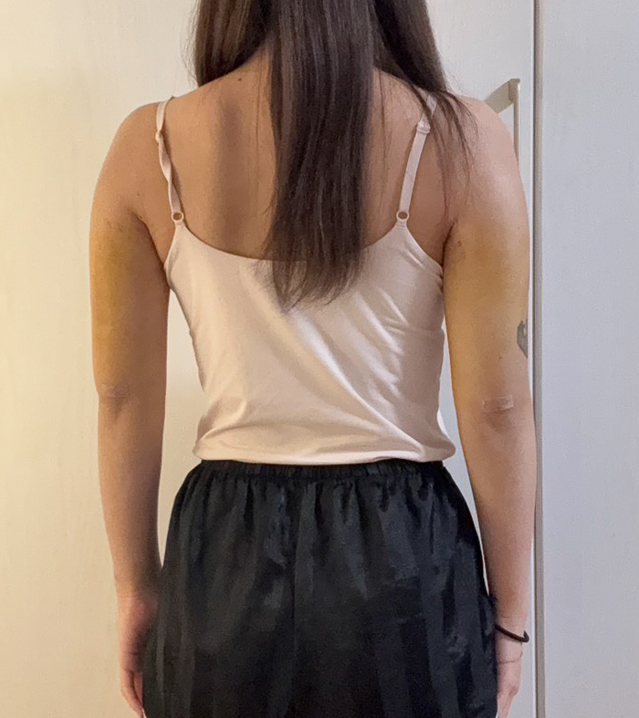 二の腕の脂肪吸引