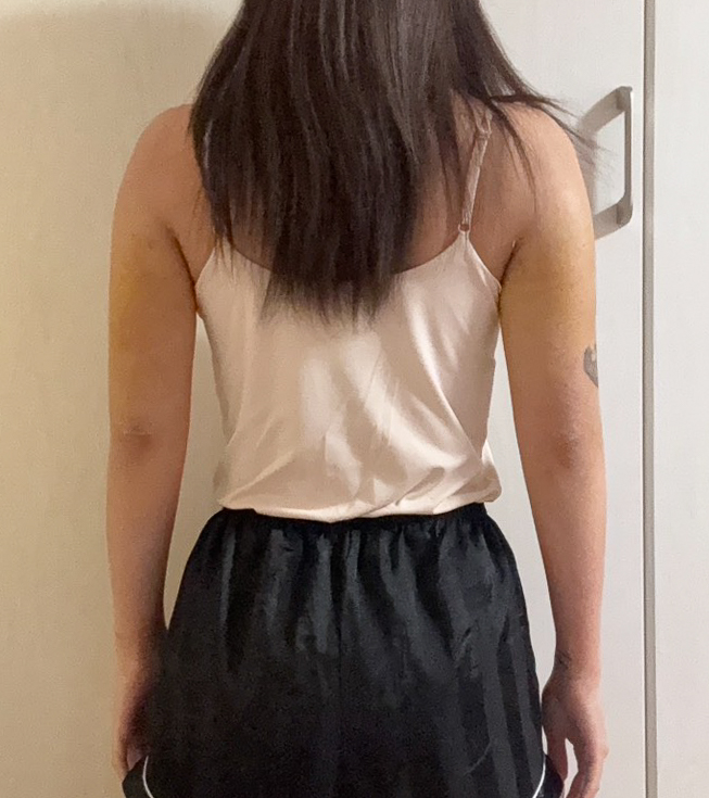 二の腕の脂肪吸引