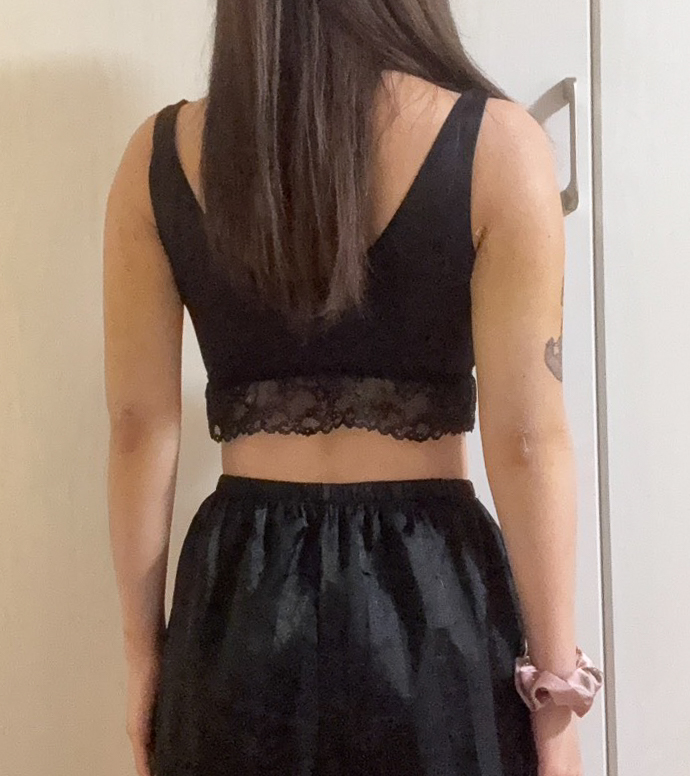 二の腕の脂肪吸引