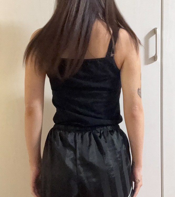 二の腕の脂肪吸引