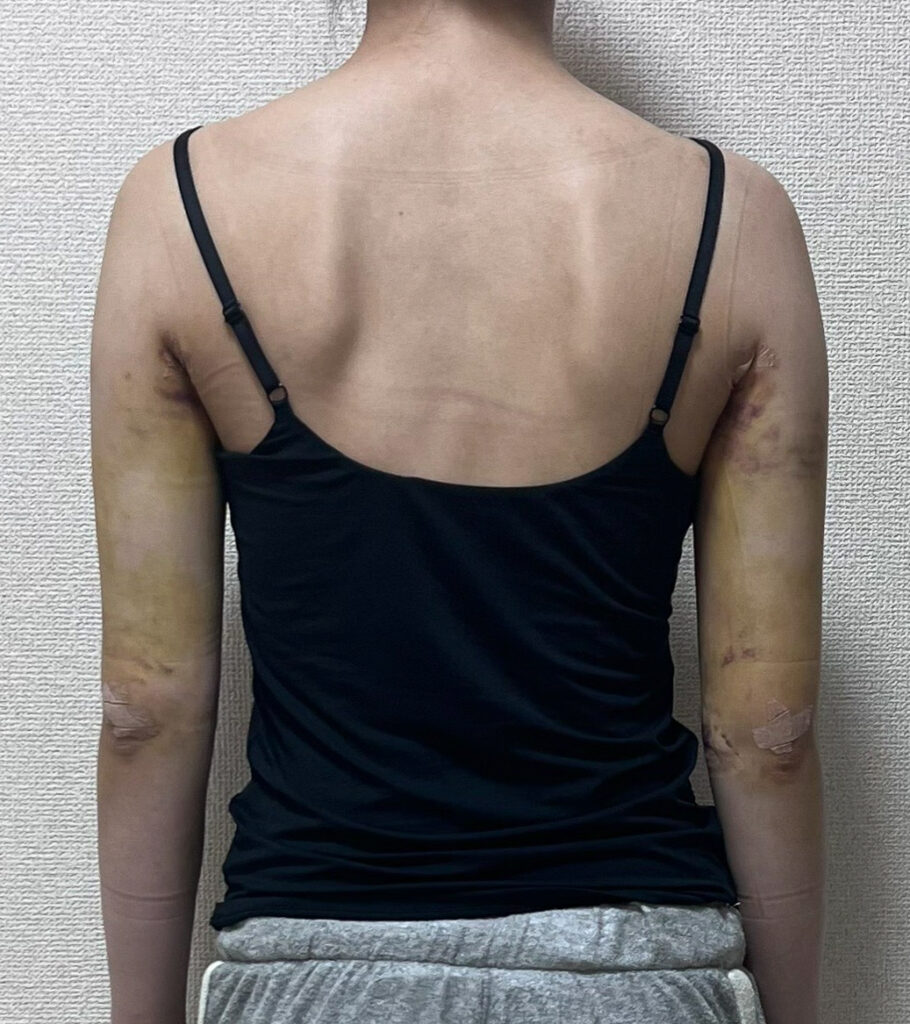 二の腕の脂肪吸引