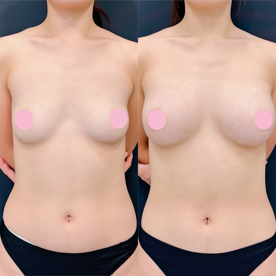 脂肪豊胸