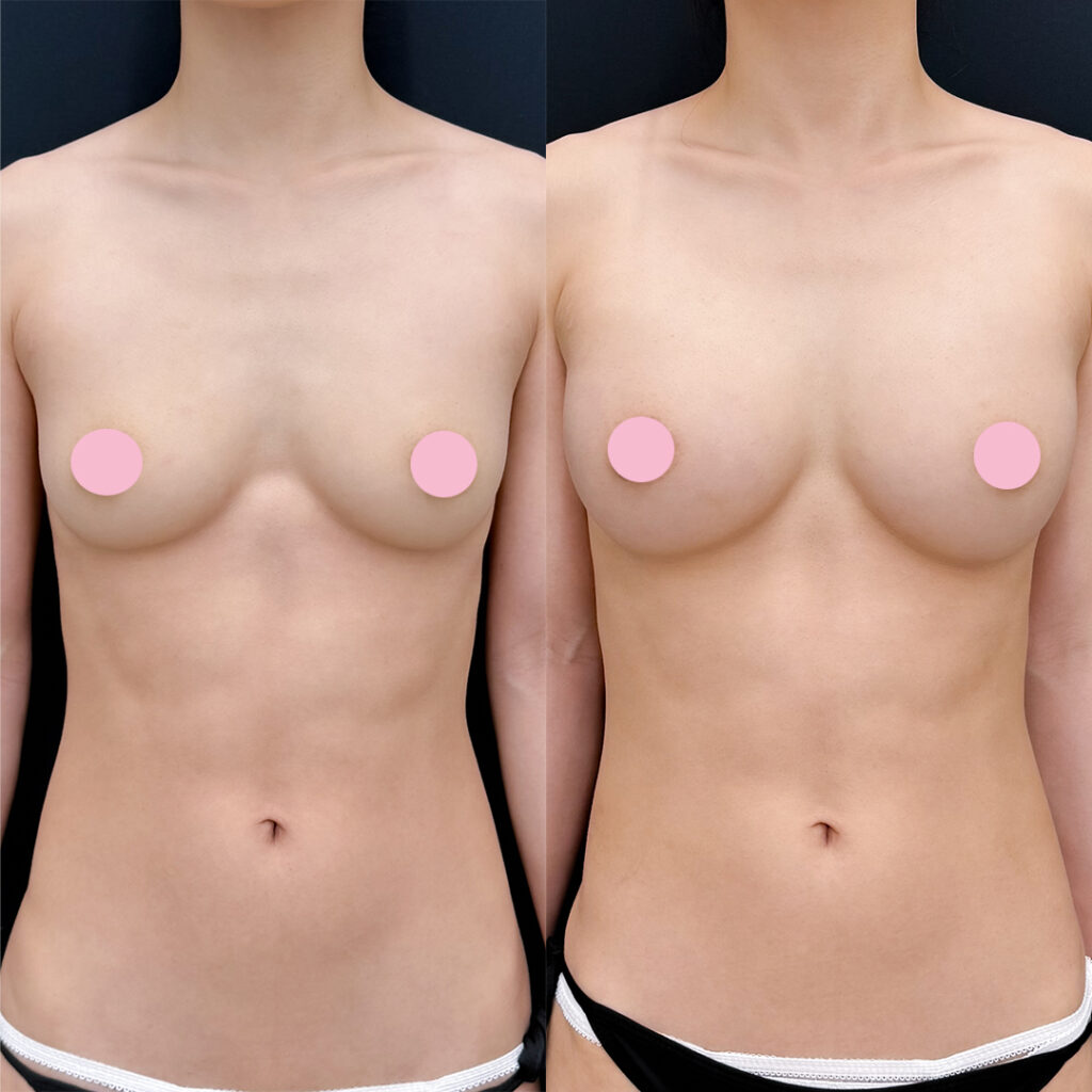 脂肪豊胸