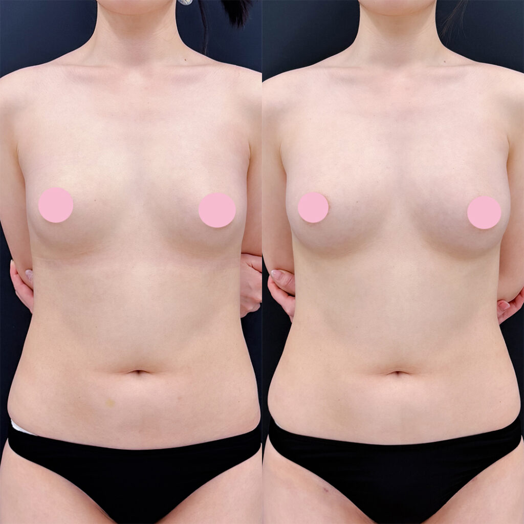 コンデンスリッチ脂肪豊胸