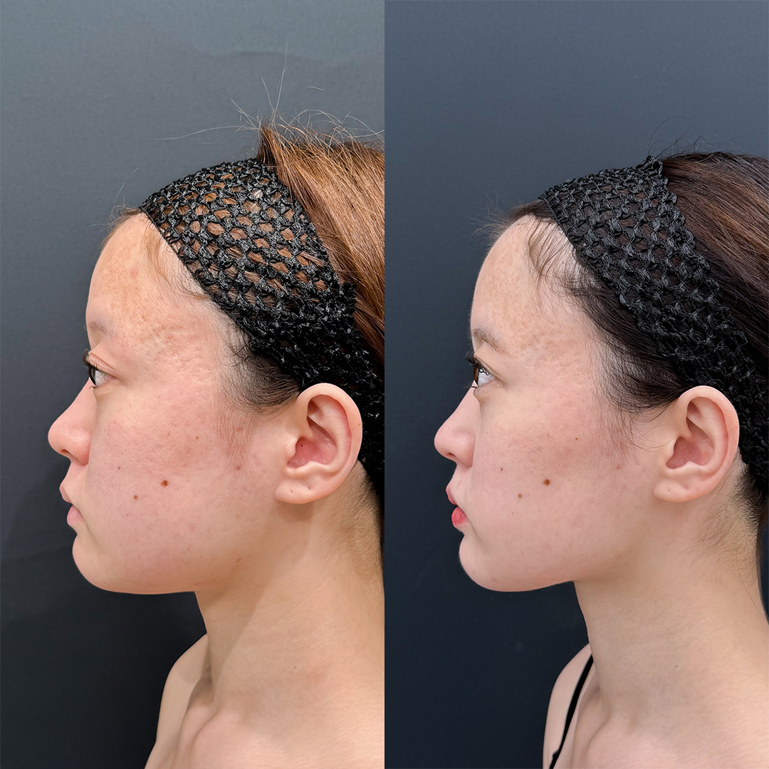 https://purelys-tokyo-clinic.com/wp/wp-content/uploads/2025/11/face-Liposuction_Case-No.110.jpg