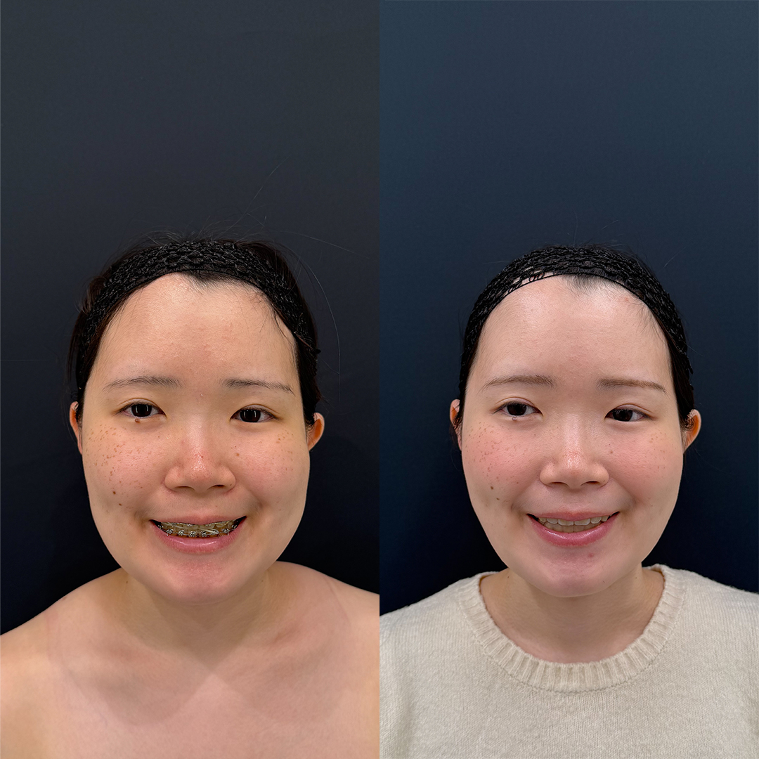 https://purelys-tokyo-clinic.com/wp/wp-content/uploads/2025/11/face-Liposuction_Case-No.45.jpg