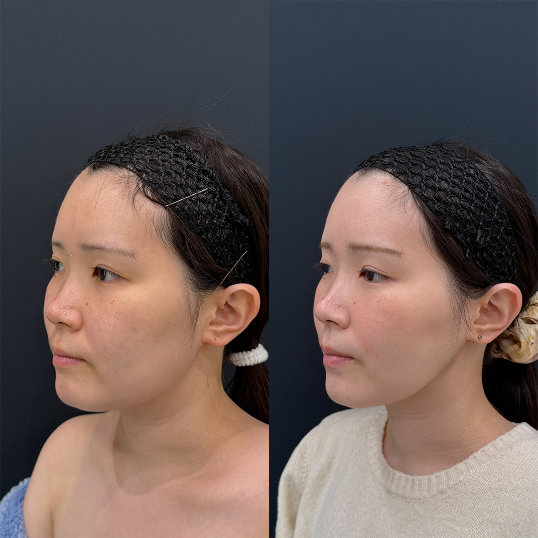 https://purelys-tokyo-clinic.com/wp/wp-content/uploads/2025/11/face-Liposuction_Case-No.46.jpg