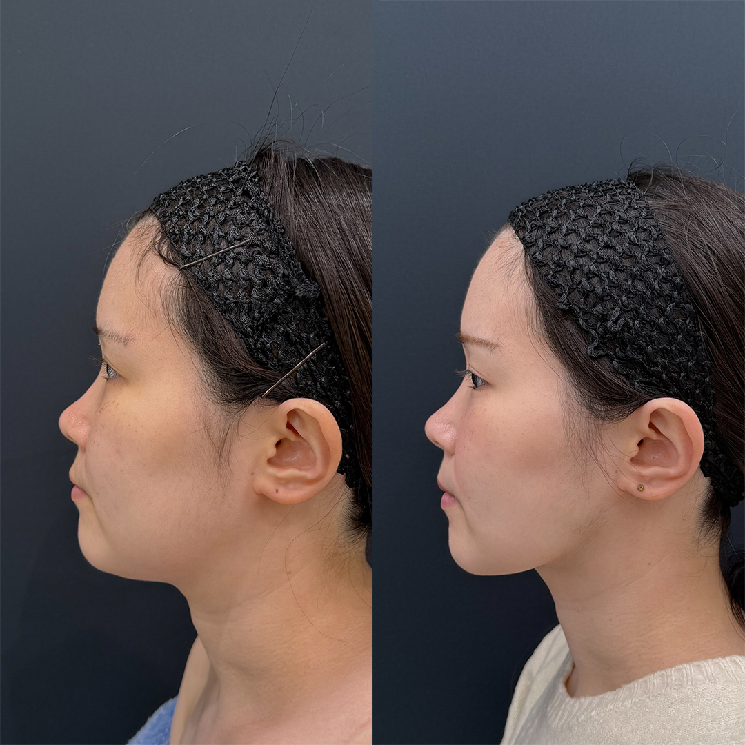 https://purelys-tokyo-clinic.com/wp/wp-content/uploads/2025/11/face-Liposuction_Case-No.48.jpg