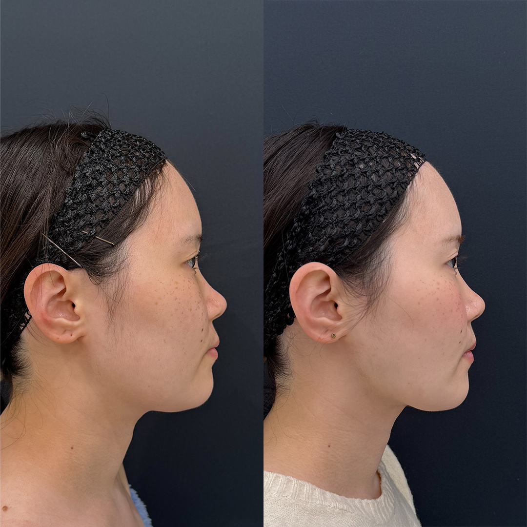 https://purelys-tokyo-clinic.com/wp/wp-content/uploads/2025/11/face-Liposuction_Case-No.49.jpg