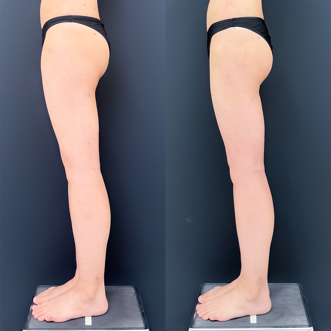 https://purelys-tokyo-clinic.com/wp/wp-content/uploads/2025/11/leg-Liposuction_Case-No.114.jpg