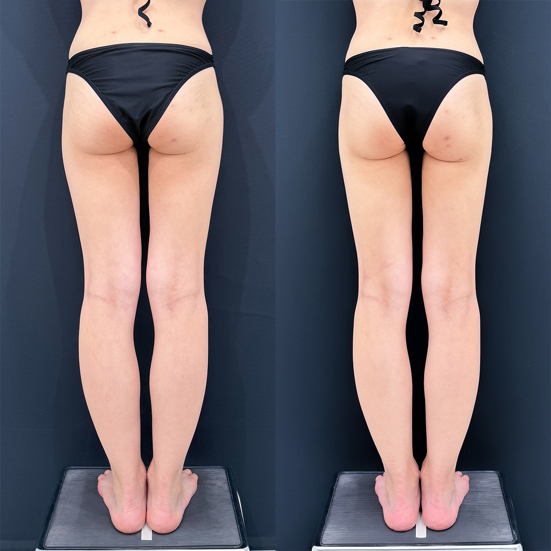https://purelys-tokyo-clinic.com/wp/wp-content/uploads/2025/11/leg-Liposuction_Case-No.91.jpg
