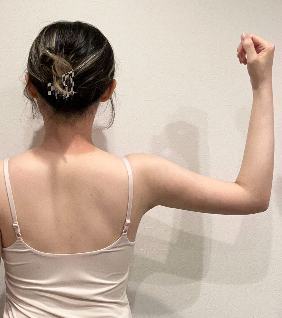 二の腕の脂肪吸引