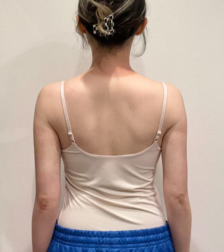 二の腕の脂肪吸引