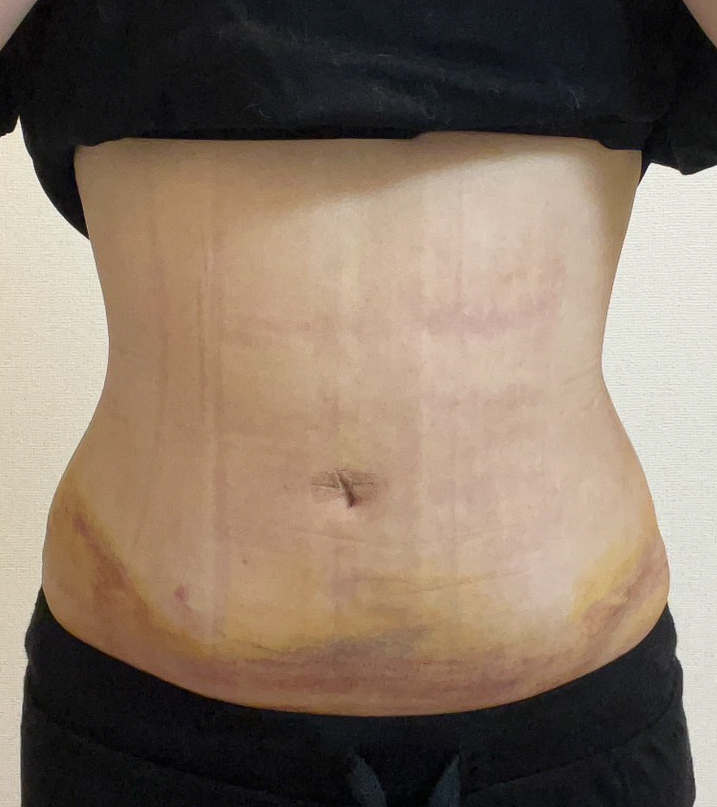 お腹の脂肪吸引