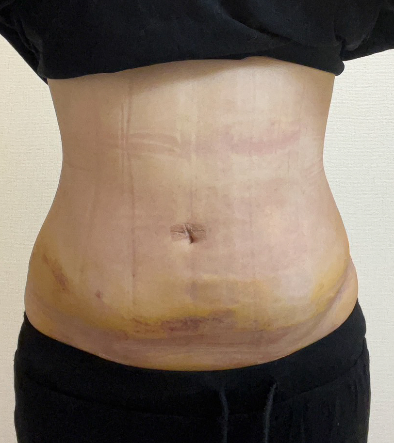 お腹の脂肪吸引