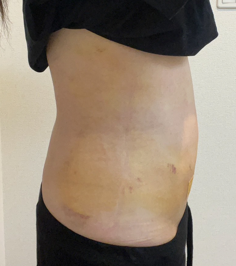 お腹の脂肪吸引