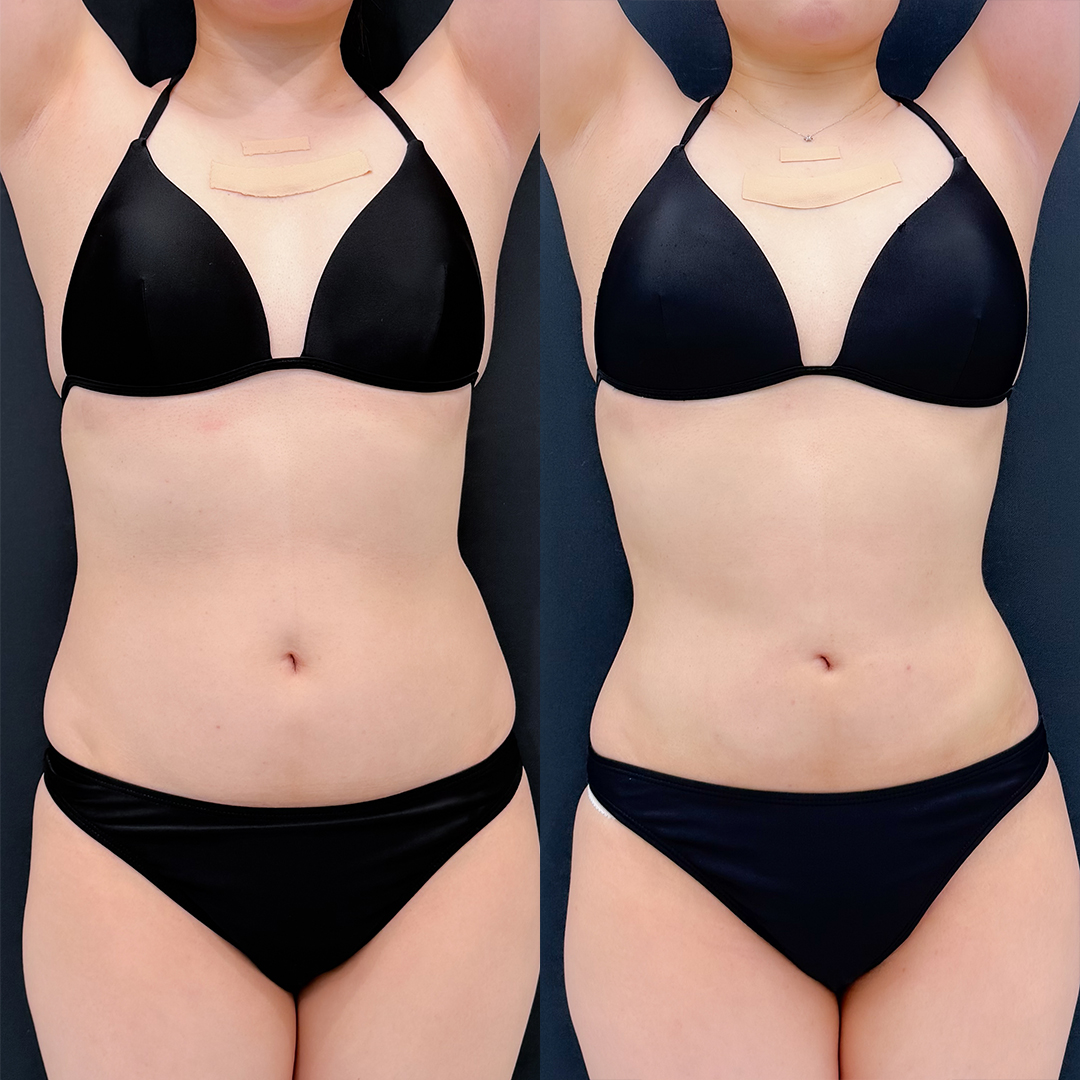 https://purelys-tokyo-clinic.com/wp/wp-content/uploads/2025/12/Before-and-After-abdominal-Liposuction_Case-No.163.jpg