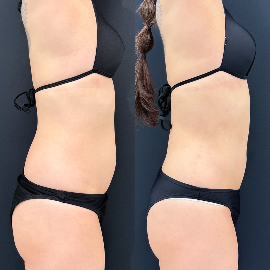https://purelys-tokyo-clinic.com/wp/wp-content/uploads/2025/12/Before-and-After-abdominal-Liposuction_Case-No.164.jpg