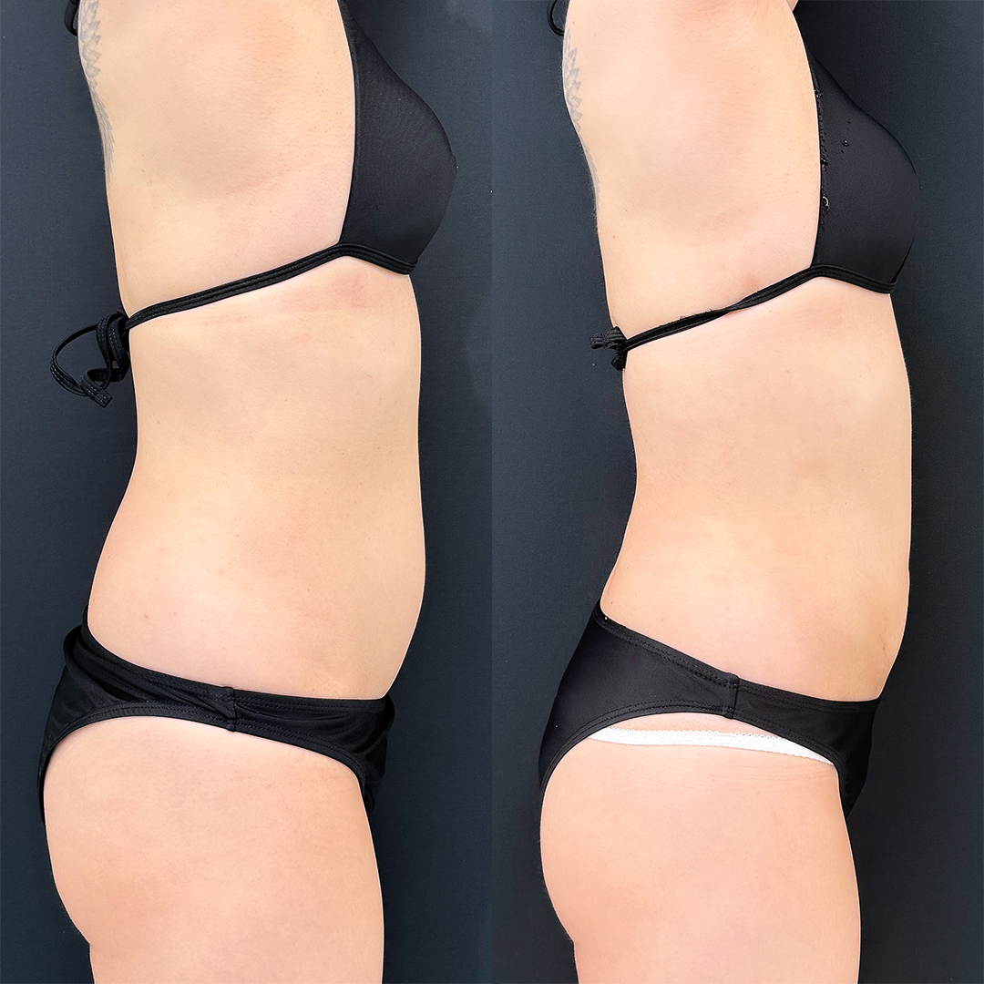 https://purelys-tokyo-clinic.com/wp/wp-content/uploads/2025/12/Before-and-After-abdominal-Liposuction_Case-No.166.jpg