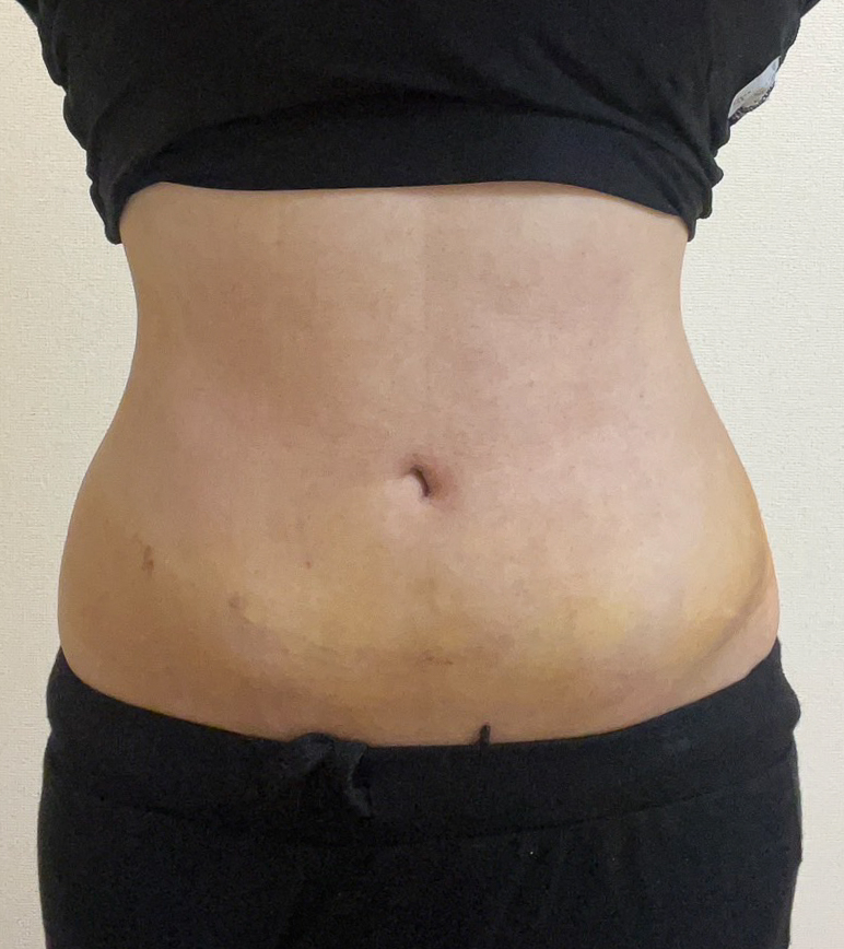 お腹の脂肪吸引