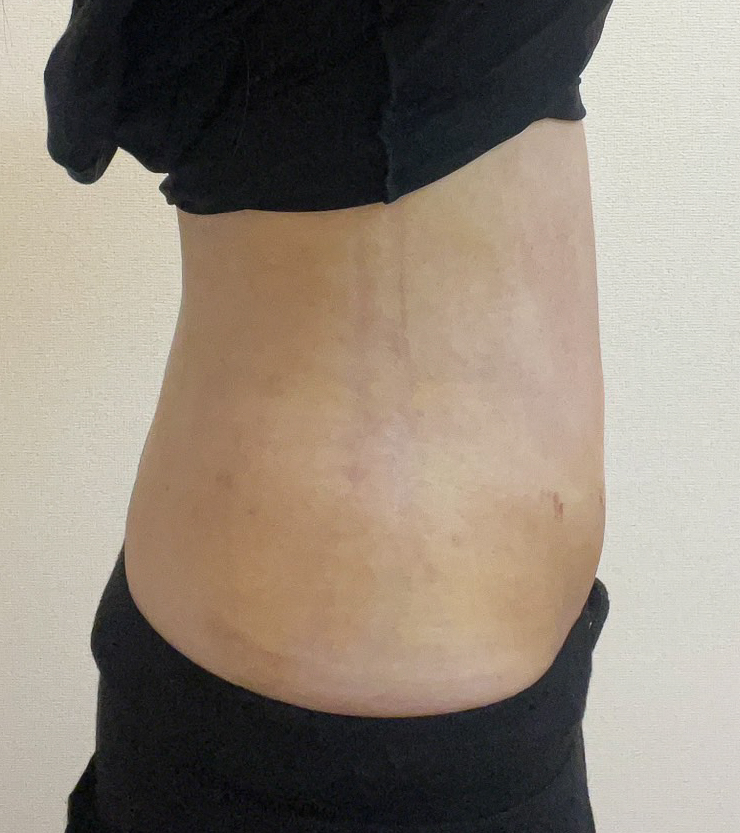 お腹の脂肪吸引