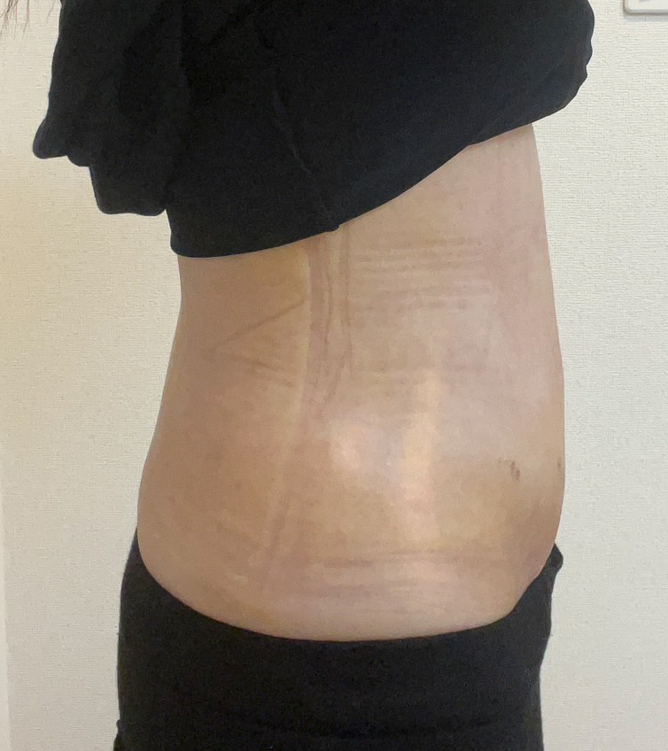 お腹の脂肪吸引