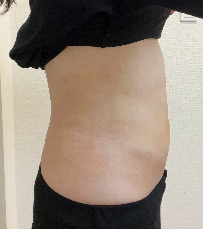 お腹の脂肪吸引