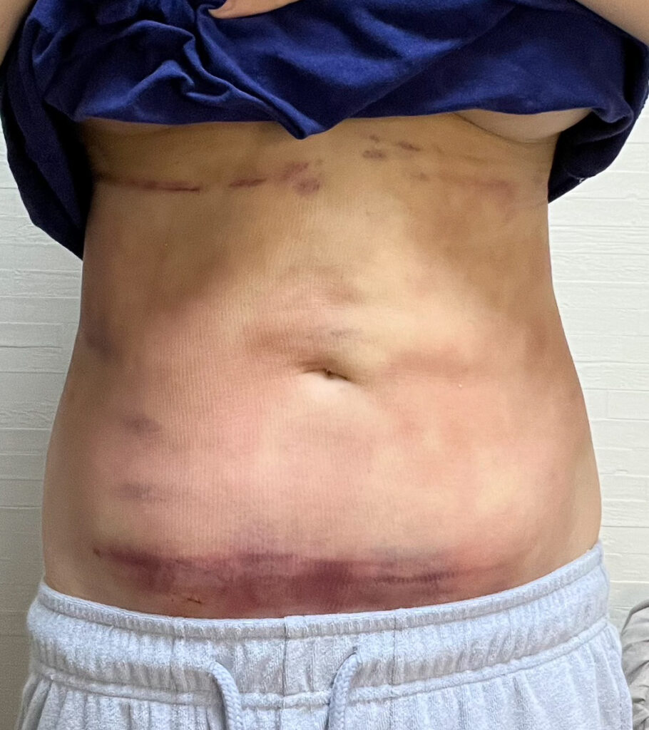 お腹の脂肪吸引