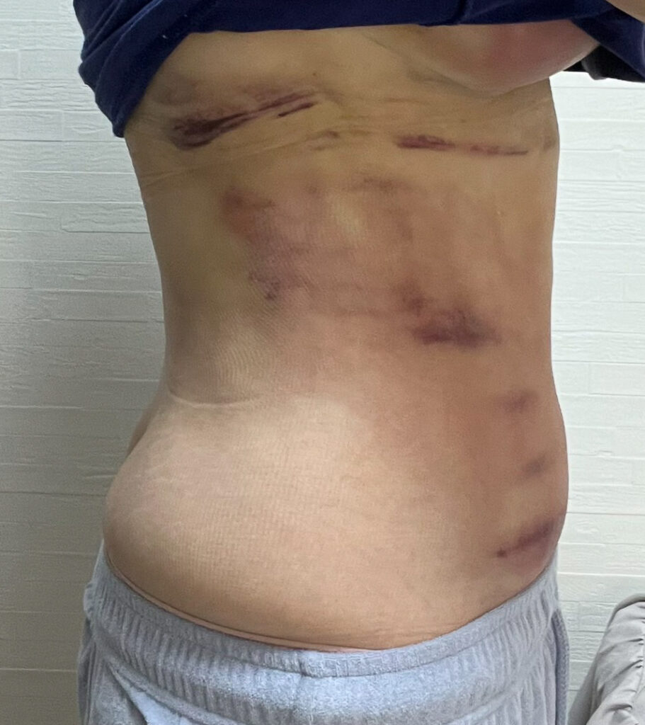 お腹の脂肪吸引